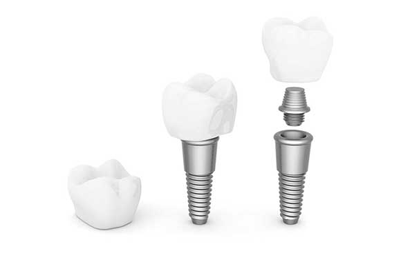 Teeth implants adelaide