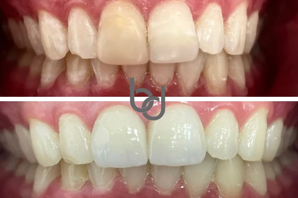 Teeth whitening before and after image