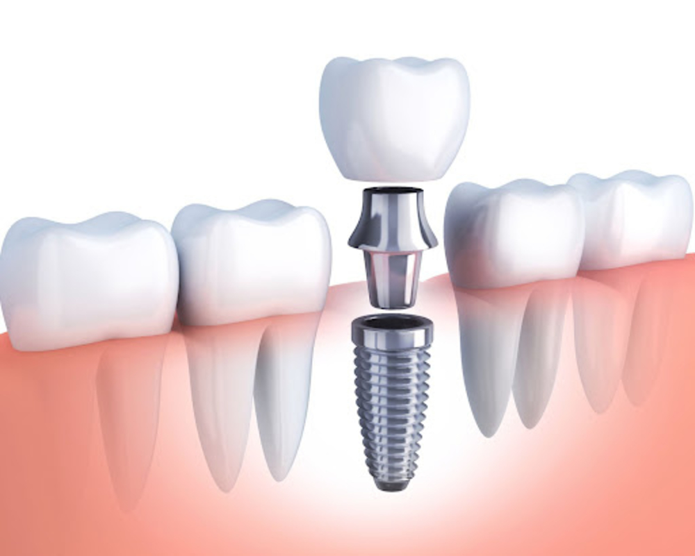 Dental implant cost in Adelaide